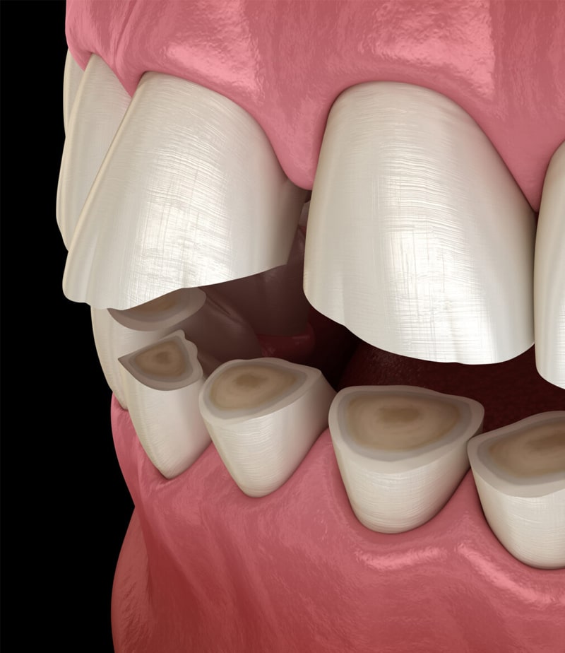 dental fillings in joplin