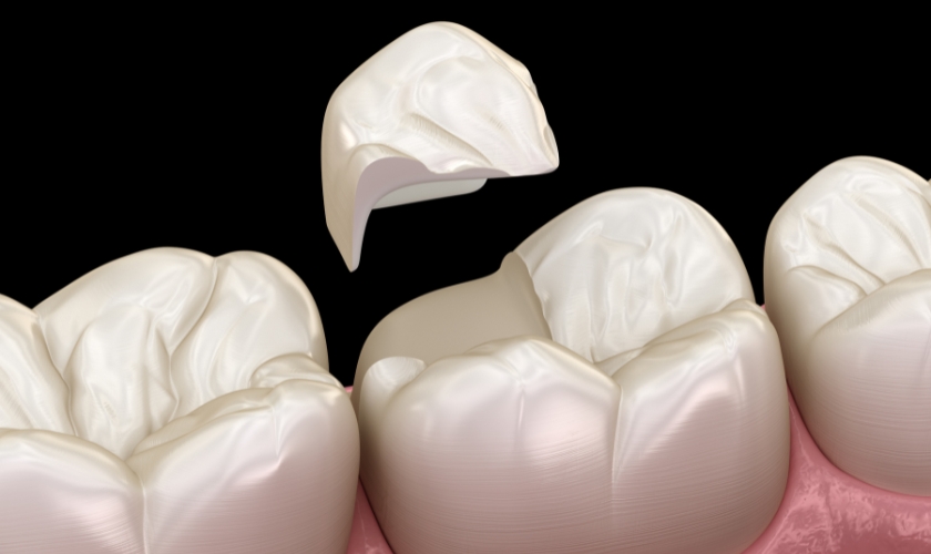 porcelain inlays and onlays conservative approach to restorations