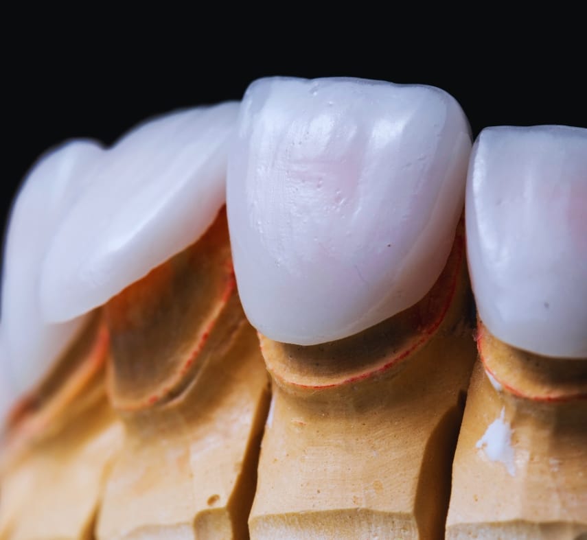 Veneers: A Permanent Solution for Your Dental Imperfections