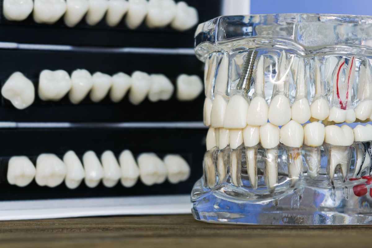 root canal therapy in Joplin