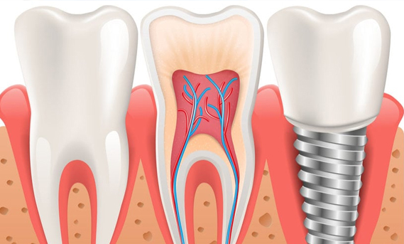 Root Canal Therapy