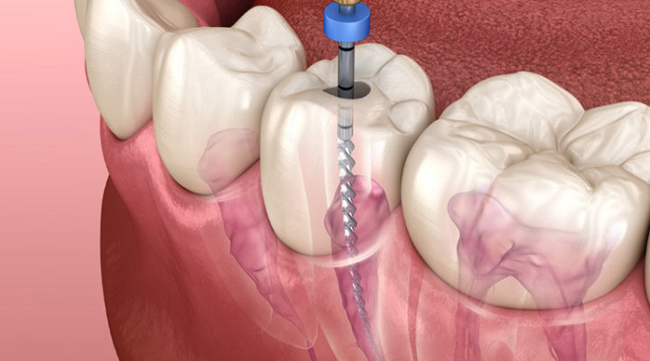 Root Canal