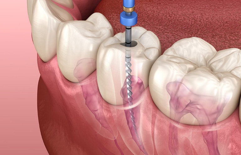 Do Children Really Need Root Canals?