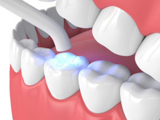 Composite dental filling