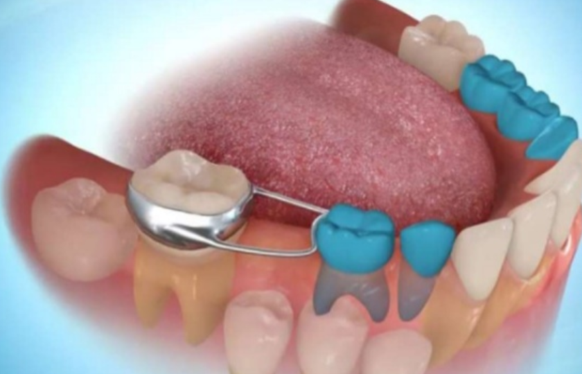 All You Need To Know About Space Maintainer Treatment