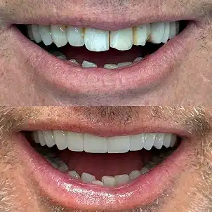 Before After New