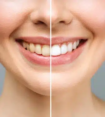 teeth whitening