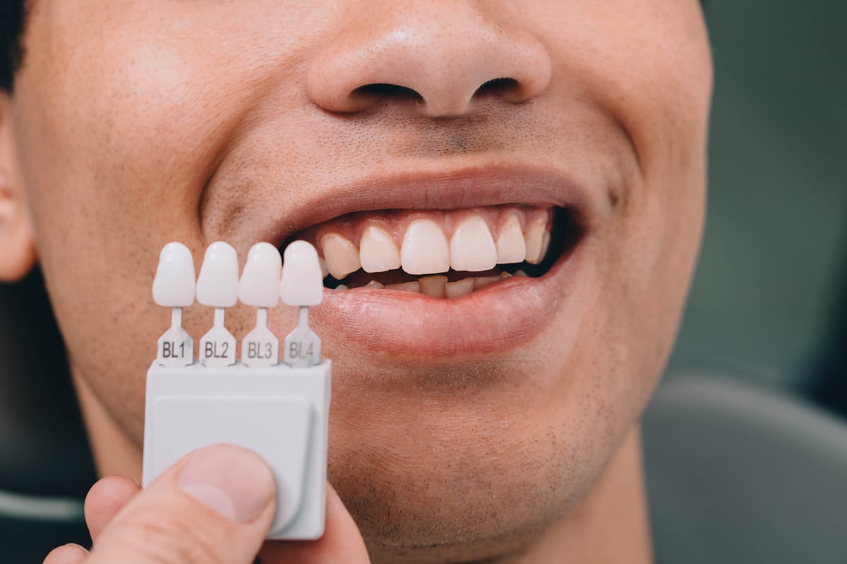 Veneers in Boca Raton