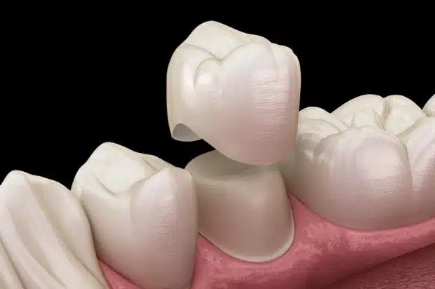 Ceramic Crowns