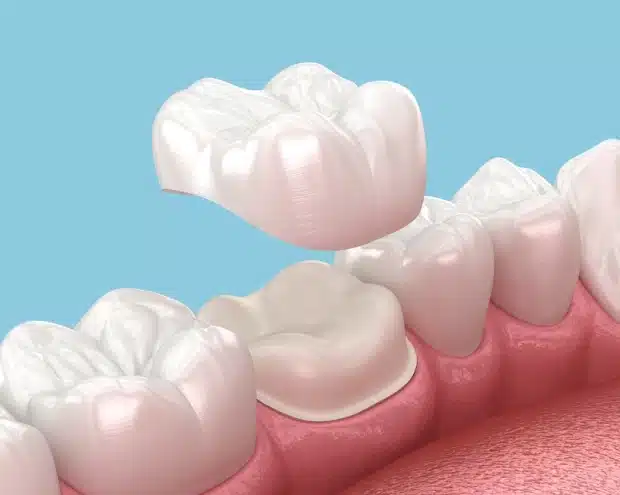 Crowns Caps