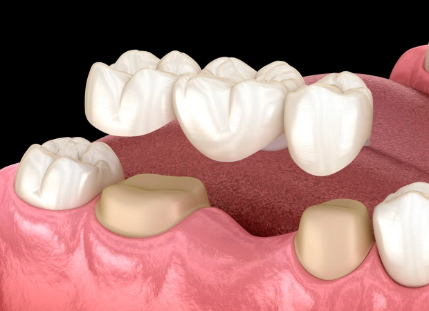 Dental Bridges