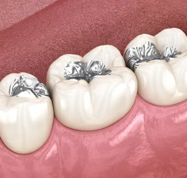 Dental Fillings