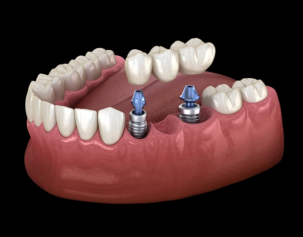 Implant Dentistry