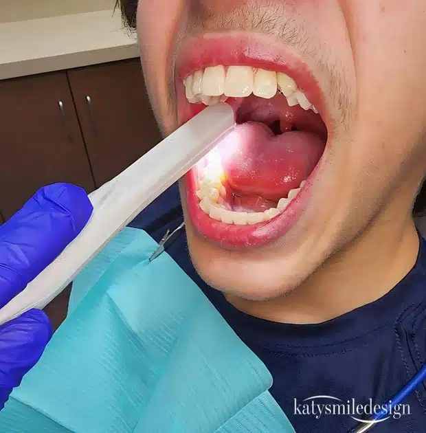 Intraoral Camera