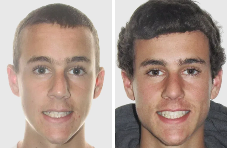 Before After Smile Transformation