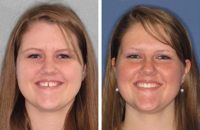 Before After Smile Transformation