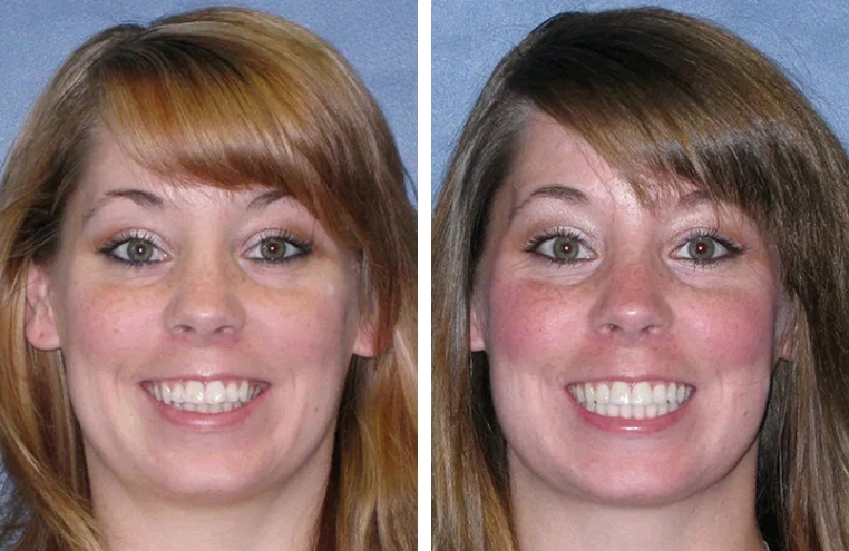 Before After Smile Transformation