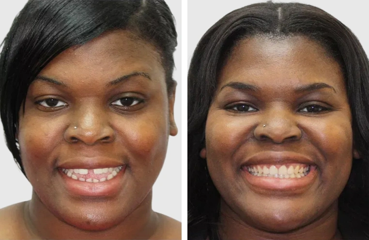 Before After Smile Transformation