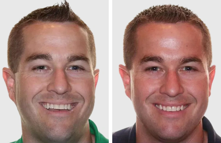 Before After Smile Transformation