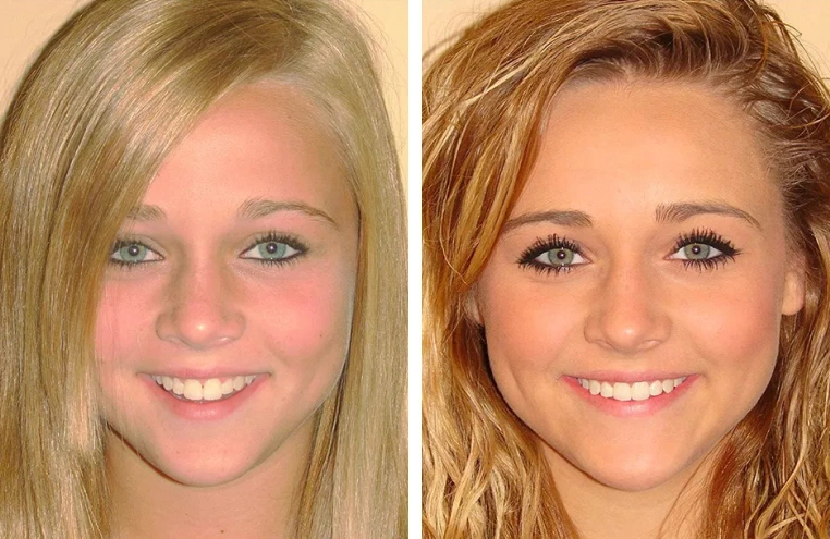 Before After Smile Transformation