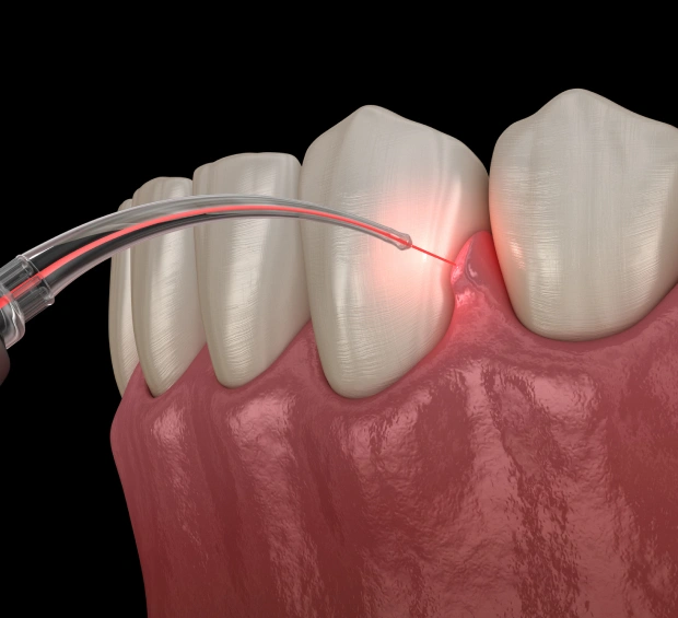 Laser Dentistry
