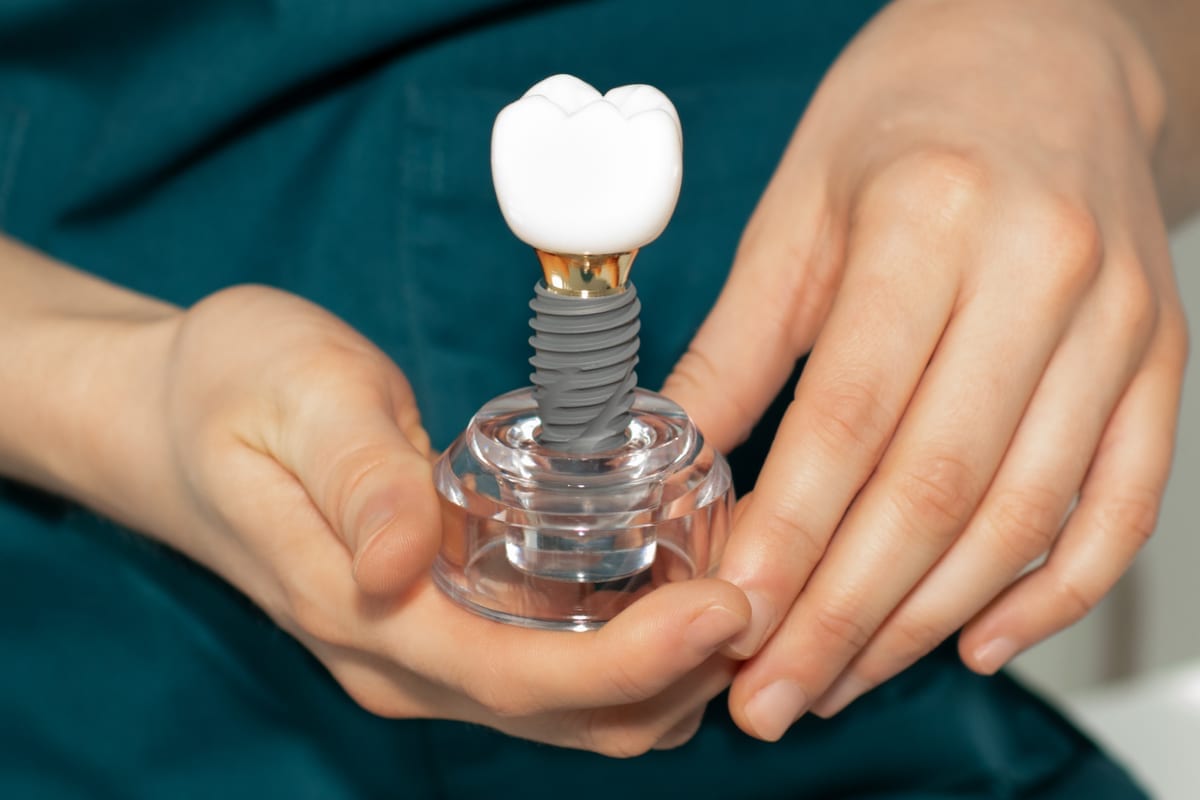 Dental Implants Cost in Katy, TX | Katy Smile Design