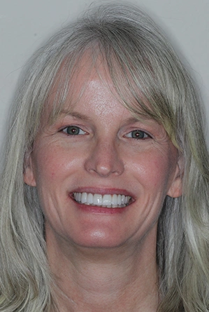 Kim smiling after full smile restoration treatment at Katy Smile Design