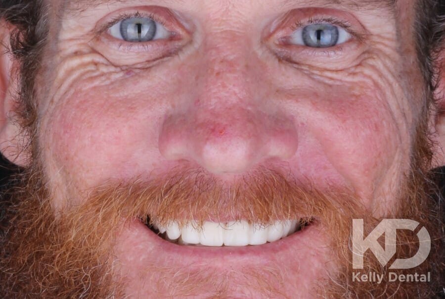 38