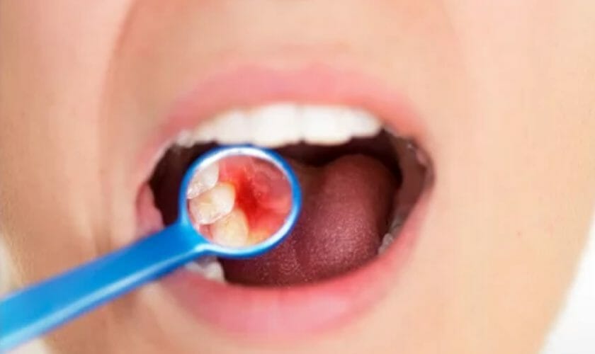 Gum Disease