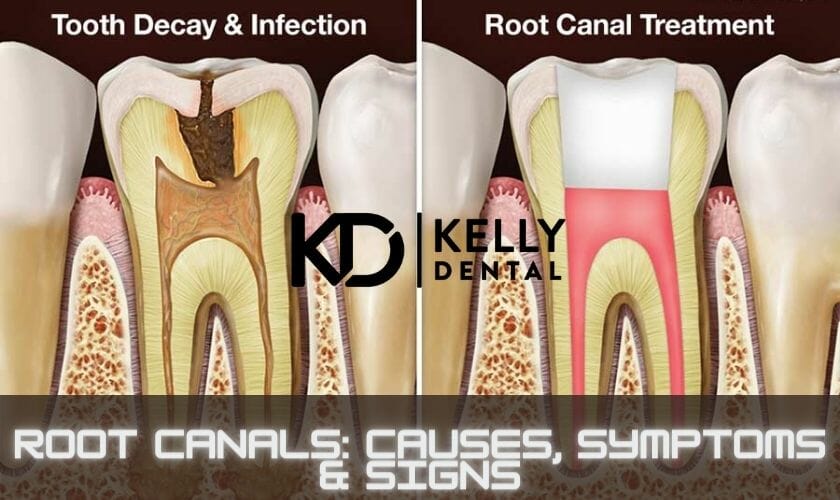 root canal in Springfield