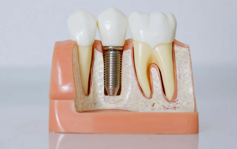 Dental Implants Springfield