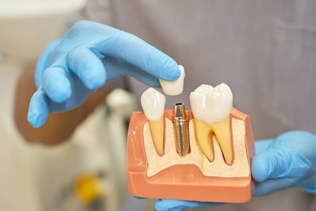 Can You Replace All Your Teeth with Dental Implants?