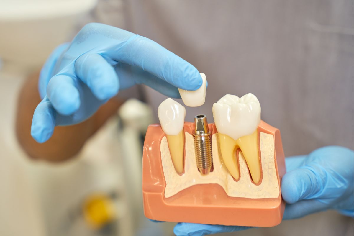 Can You Replace All Your Teeth with Dental Implants?