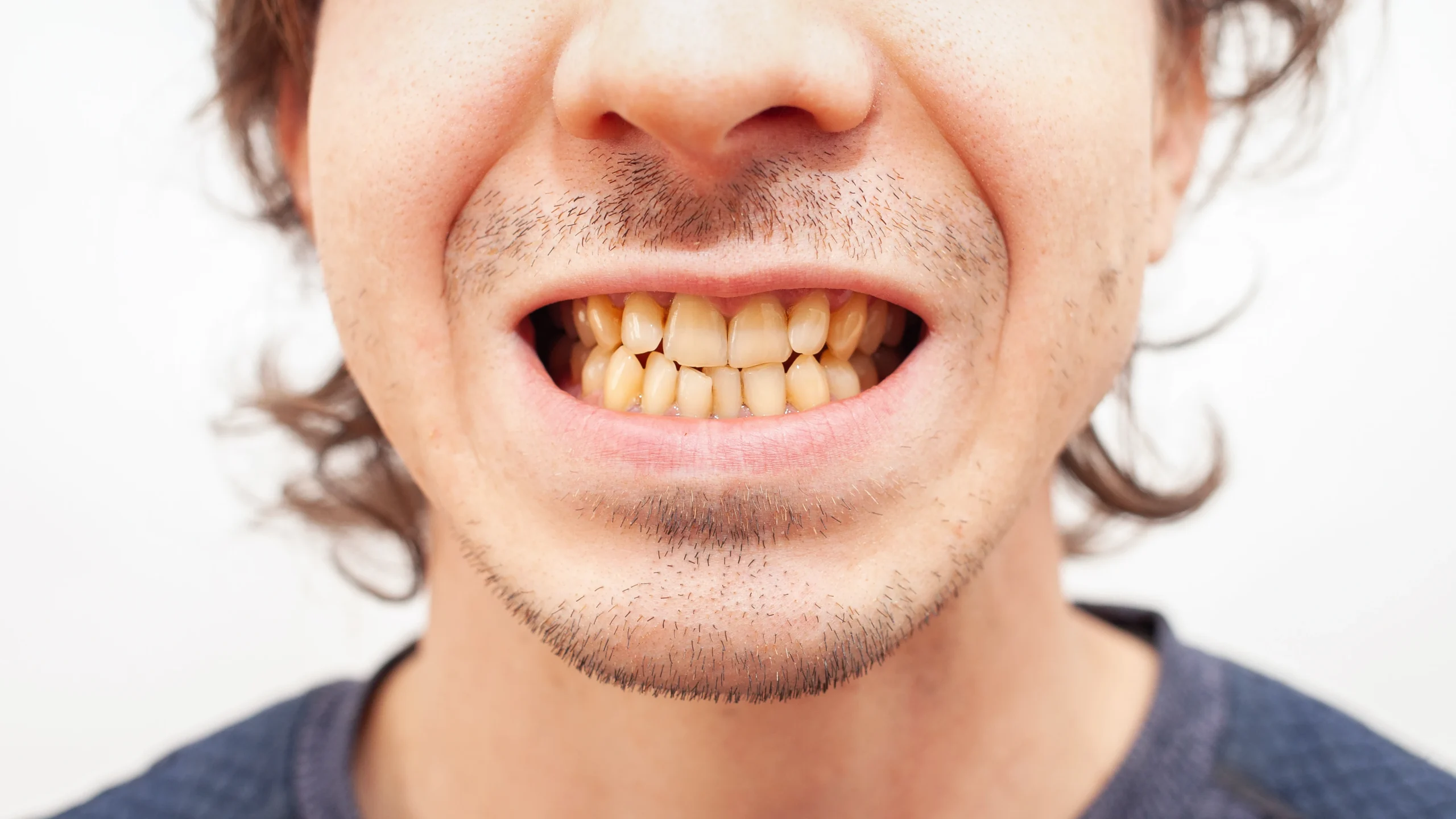 patient with yellow teeth at Kyle Parkway Dentistry