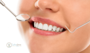 Teeth Whitening