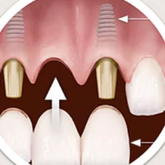 Implant-Bridges-img
