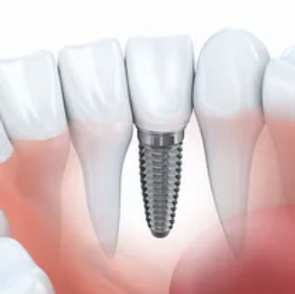 Single-Tooth-Replacement-img