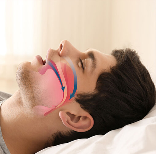 The-Facts-on-Snoring-Sleep-Apnea