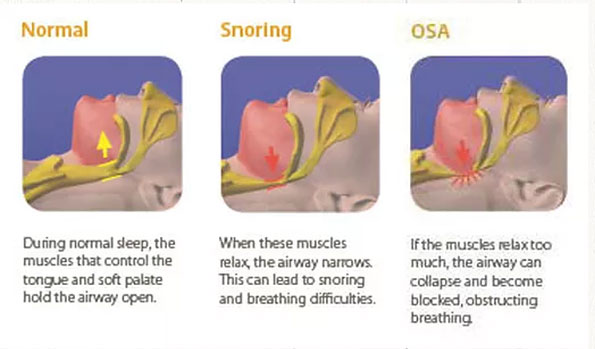 snoring_img