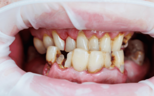 What Are The Options For People With Bad Teeth