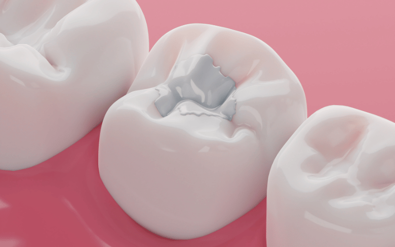 Are White Fillings Better For Teeth