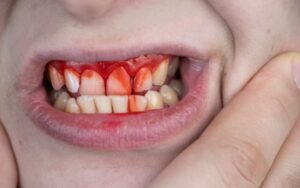 How Effective Is Gum Therapy for Bleeding Gums