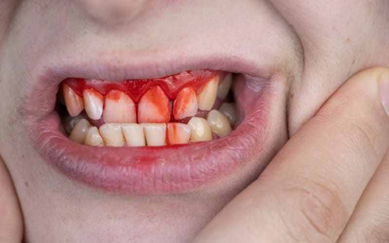 How Effective Is Gum Therapy for Bleeding Gums