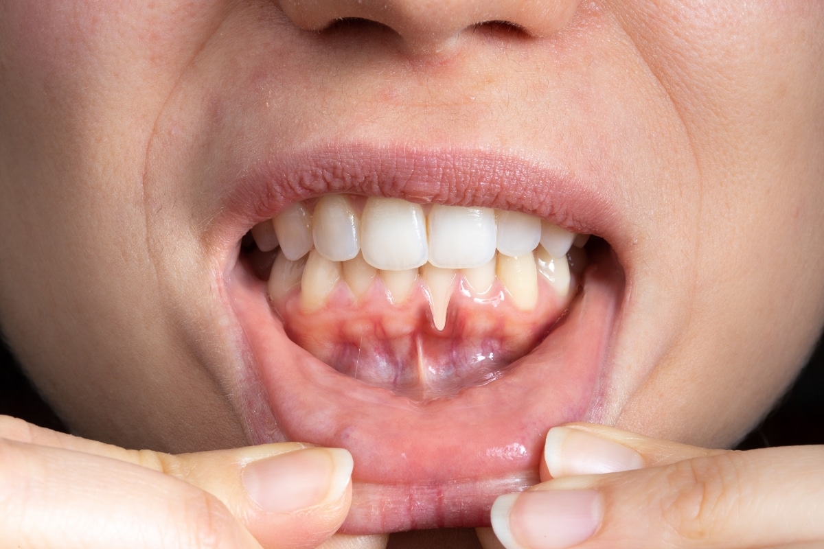 Periodontal Treatment
