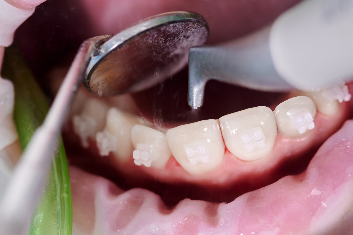 laser-gum-treatment-in-Hugo