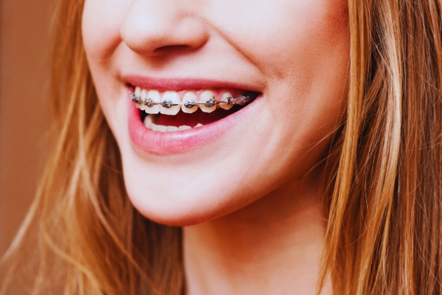 a girl smiling after complete her braces attached in League City, TX