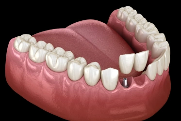 Dental bridges in Lilburn