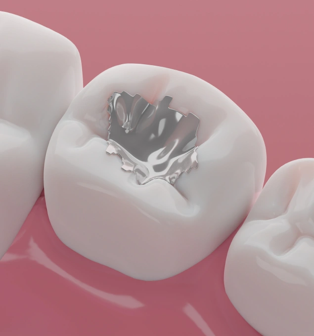Prevent cavities with composite dental fillings at Lilburn Smile Makers Dental in Lilburn, Georgia