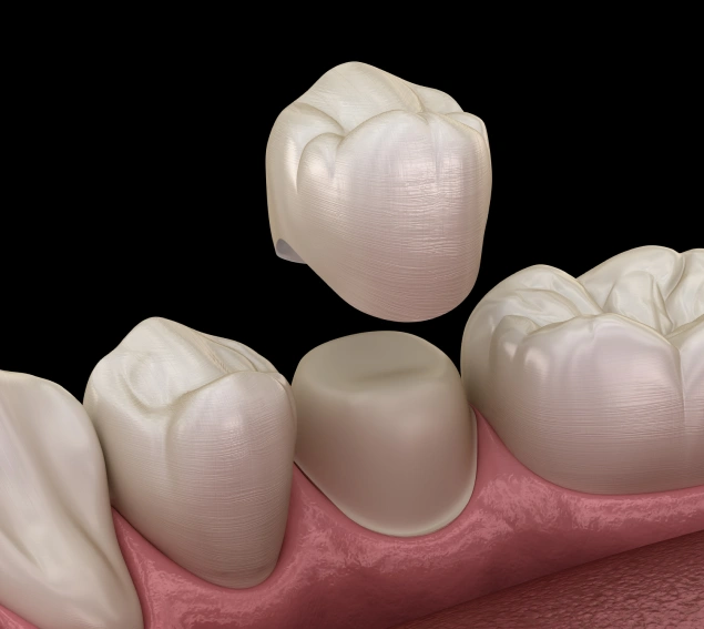 Restore Your Smile with Dental Crowns at Lilburn Smile Makers Dental in Lilburn, Georgia