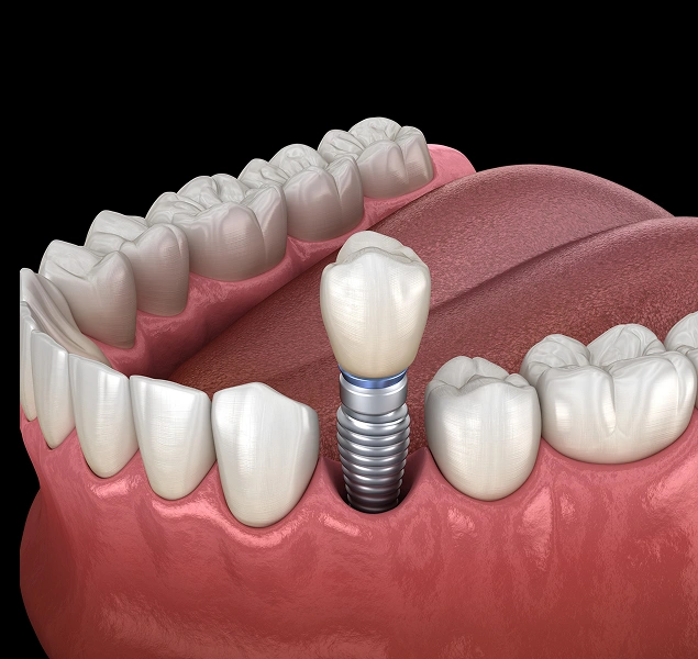 Replace missing teeth with dental implants at Lilburn Smile Makers Dental in Lilburn, Georgia